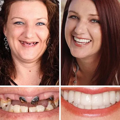 🏆Ends Today: 70% OFF!  🏆2026 Bestselling Product🦷 Fit for a Fresh Smile, Say Goodbye to Wearing Discomfort!🌎